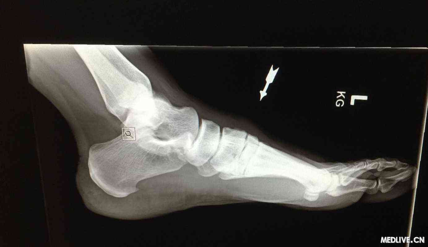 患者脚背出现新的疼痛肿块。大家认为可能的诊