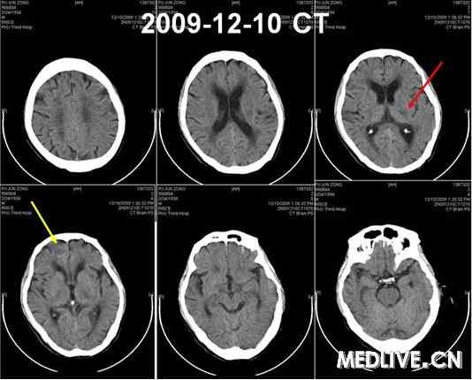 头ct:右侧额叶少量出血,较前吸收,左侧基底节区小片状低密度灶2009年