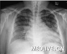 胸部X光显示，心脏肥大及两侧肺血管充血