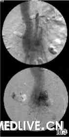 腹主动脉血管造影，在显影剂注入腹主动脉后，快速地流入脊髓动脉，接着流入下腔静脉， 肾动脉无明显狭窄