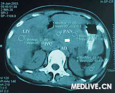 腹部CT示胰腺体部软组织肿块