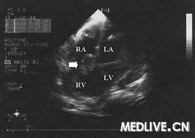 UCG示右房、右室间肿块