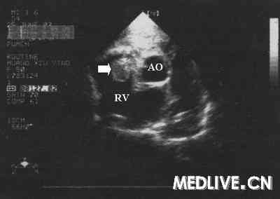 UCG示右室内肿块