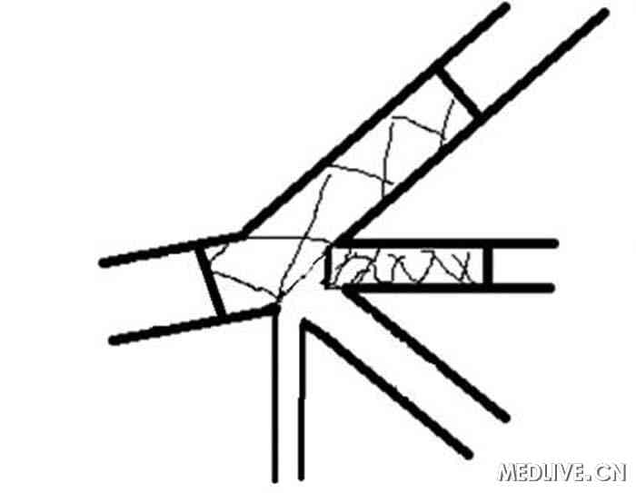 介入治疗左主干四分叉病变治疗病例解读 “k”支架术式