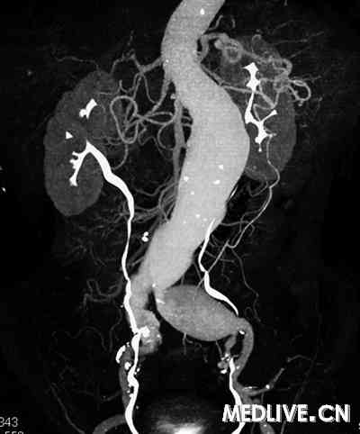 腹主、左髂总动脉瘤形成