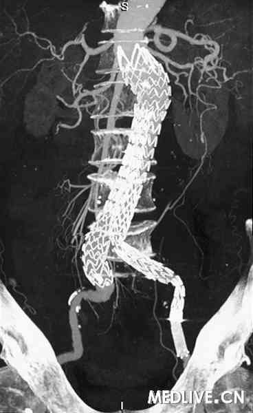  覆膜支架腔内修复术后