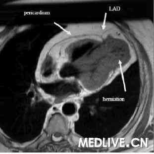  MRI  先天性部分心包缺如