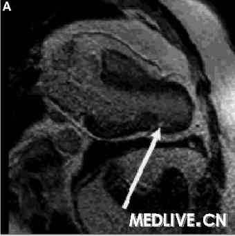 MRI 先天性部分心包缺如