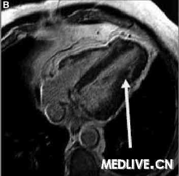 MRI 先天性部分心包缺如