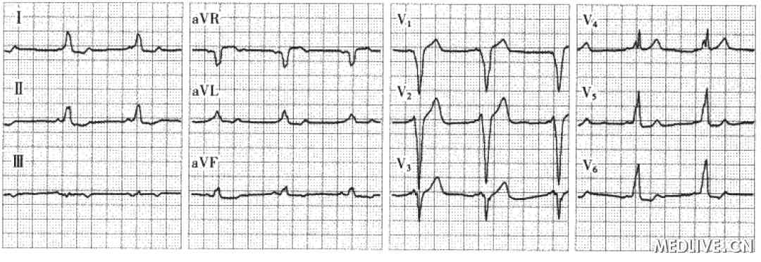 静息ECG 示B型预激