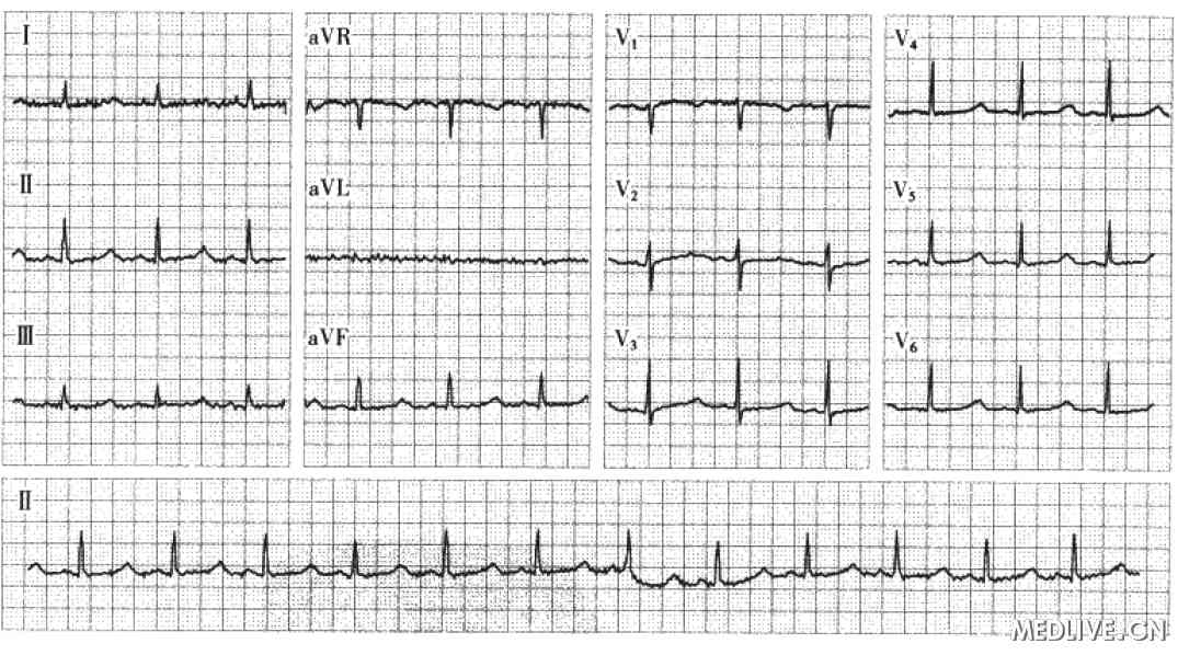 ECG  QT间期延长