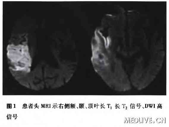 头颅MRI表现