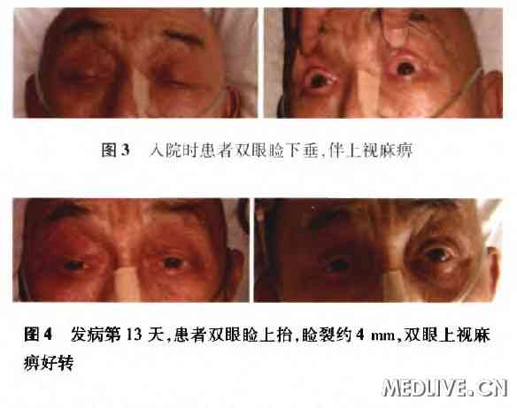 患者双侧眼睑下垂