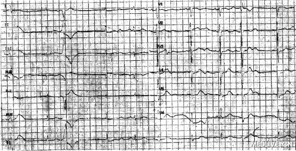 阿奇霉素合用甘草导致心律失常