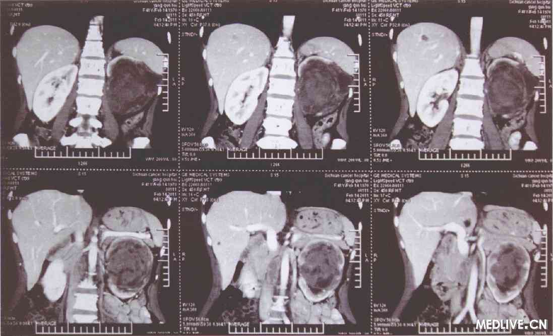 图2　CT 检查结果提示左肾恶性肿瘤伴出血坏死可能性大