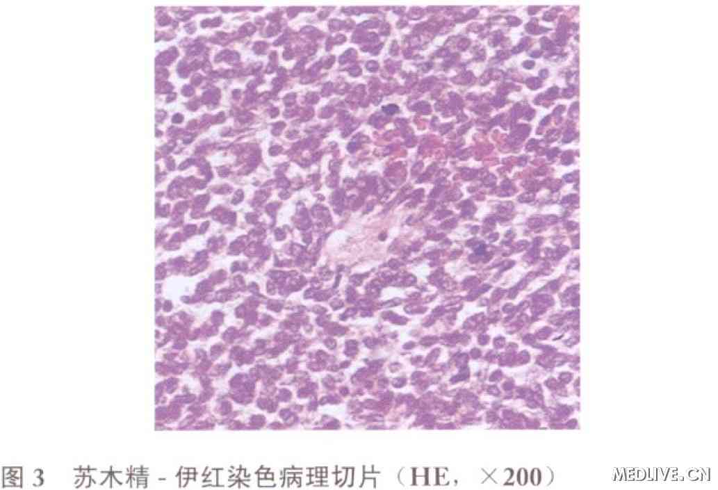 肾脏巨大尤因肉瘤/原始神经外胚叶肿瘤
