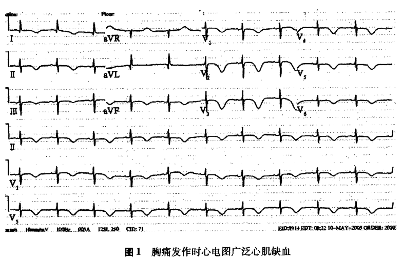 图1 心电图.PNG