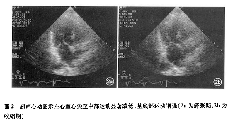 图2 超声心动图.PNG