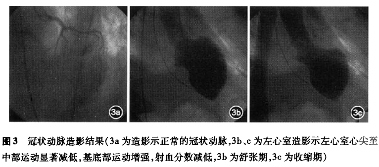 图3 冠脉造影.PNG