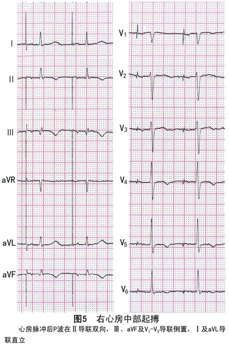 故起搏产生的p波在方向,形态及时间上均与窦性心律时相似,即p波在Ⅰ
