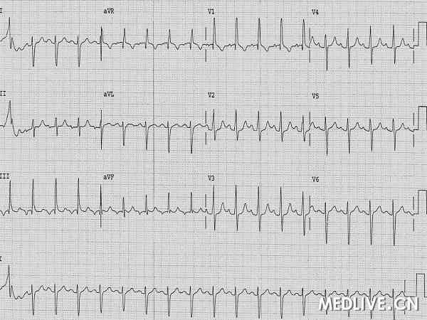 患有严重的特发性肺动脉高压,图为做常规检查时的心电图,脉冲加快