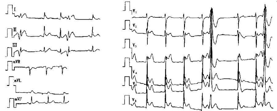 brugada综合征患者体表心电图