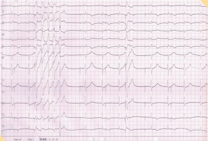 读图解析:起搏器功能的初步判断