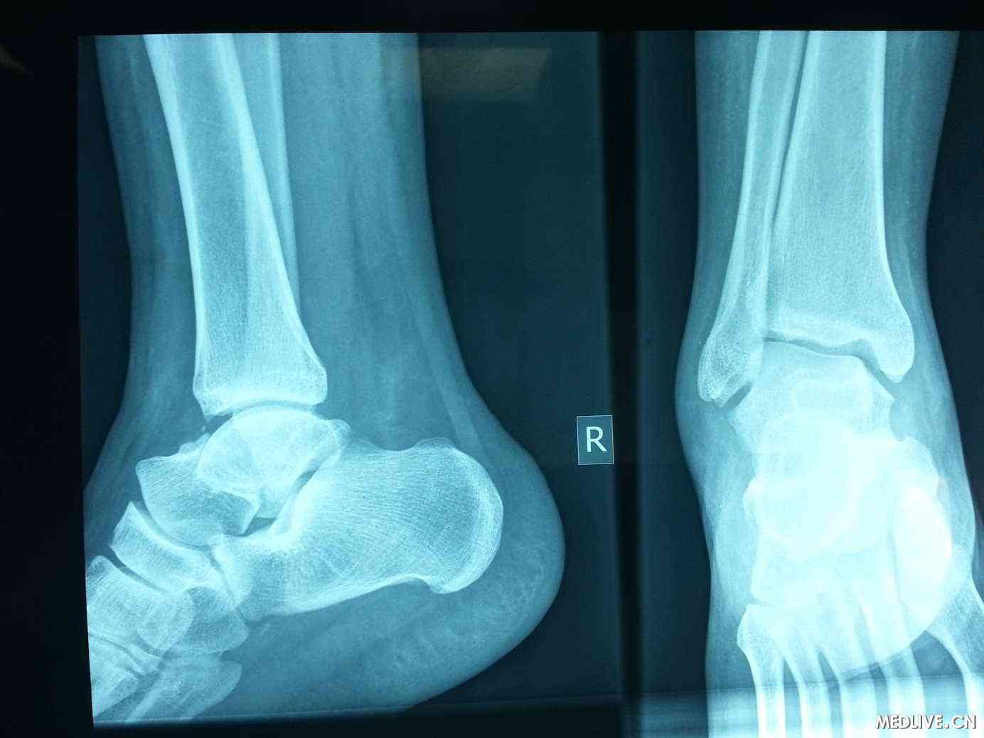 右脚一周前出现肿胀症状,按照脚踝扭伤治疗,患者的右脚踝x光显示正常.