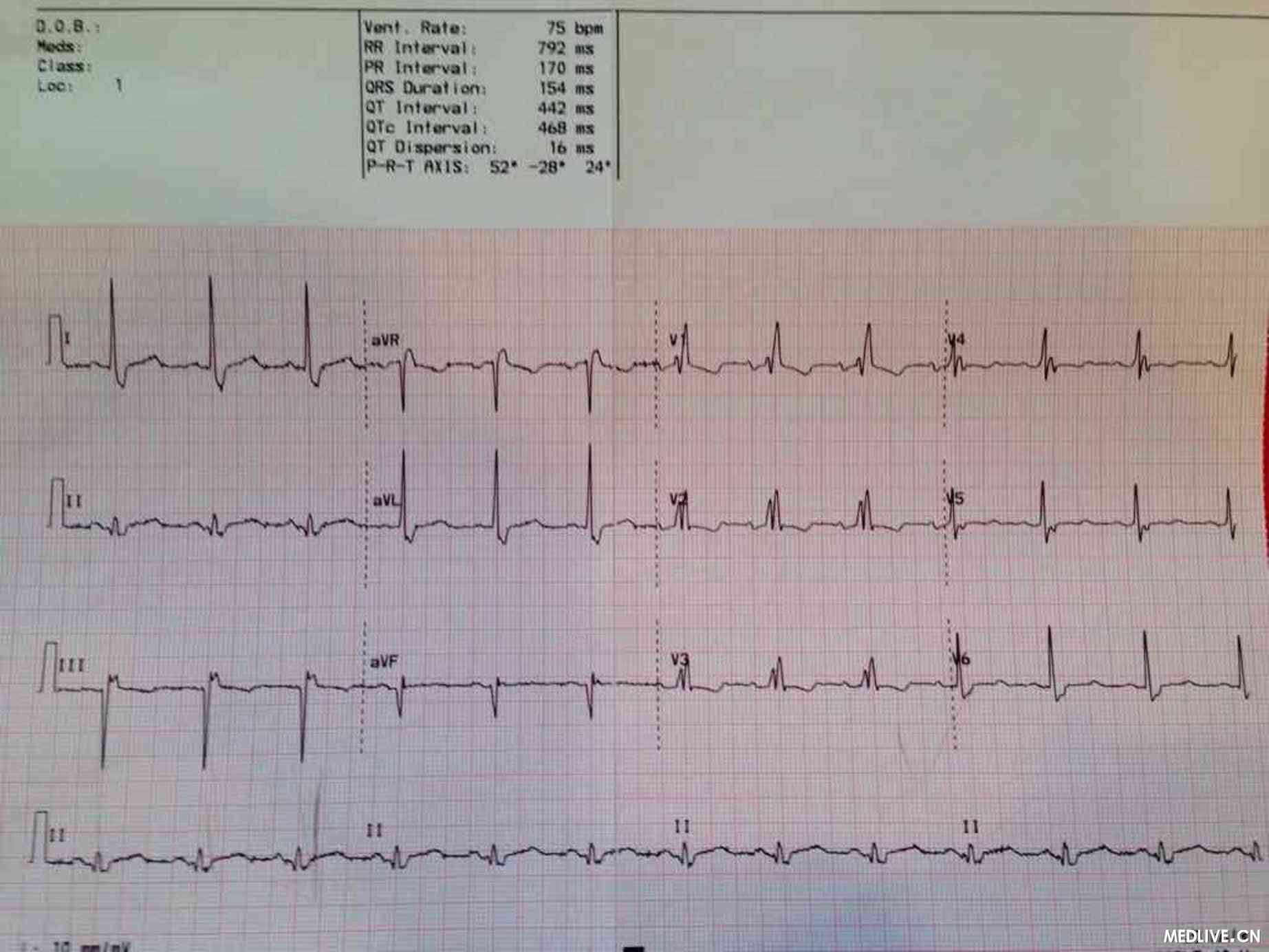 患者的这张心电图应该怎样解析?