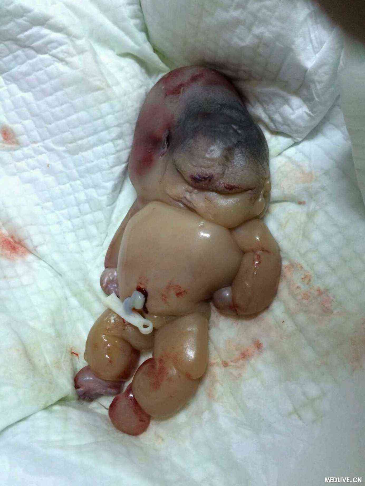 孕妇,32岁,妊娠32周分娩,P1(+)A0,为什么会出现