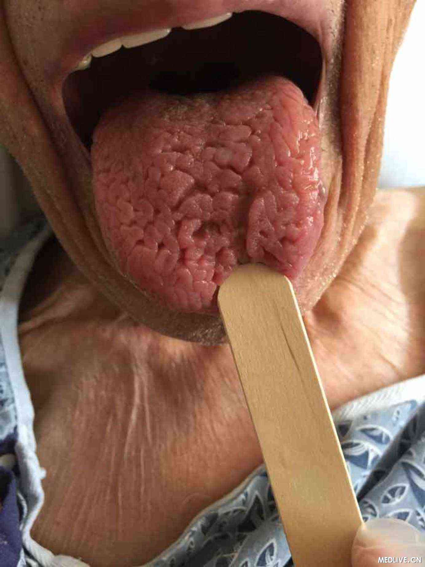 舌头出现裂纹,我从来没见过这么深的,可能的诊断是什么呢?