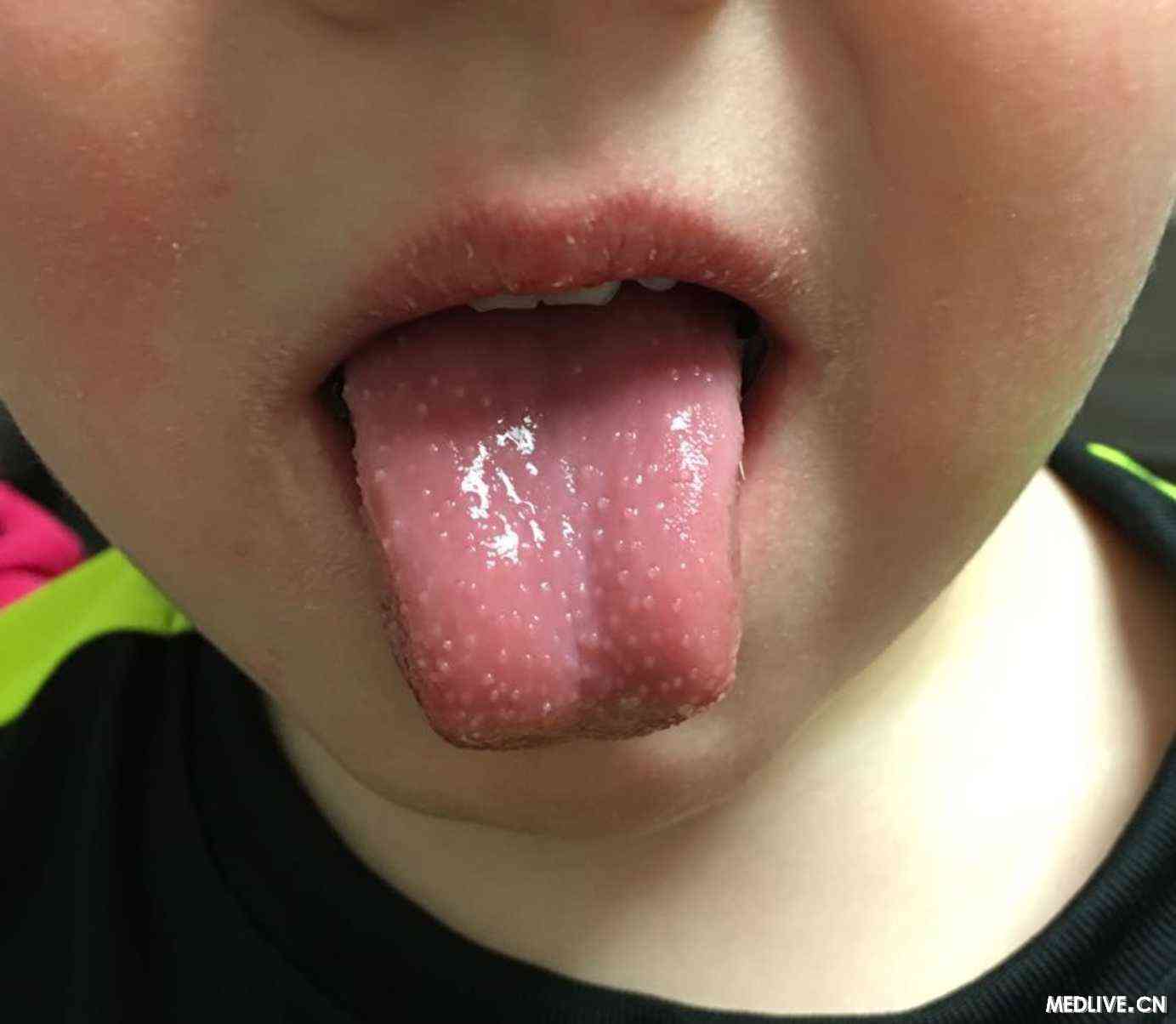 患者,发烧,裂痕唇,脸上有干疹,舌头呈现出如图所示额症状,可能的诊断