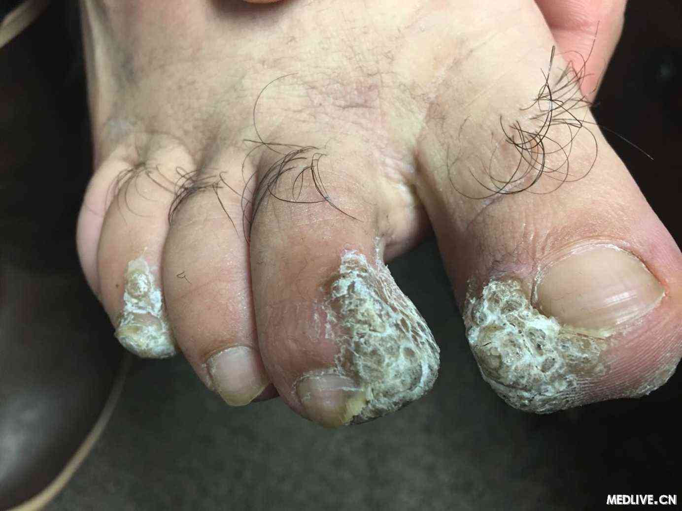患者,25岁,男性.诊断为脚癣,但是我怎么觉得是疣呢?大家觉得是什么?