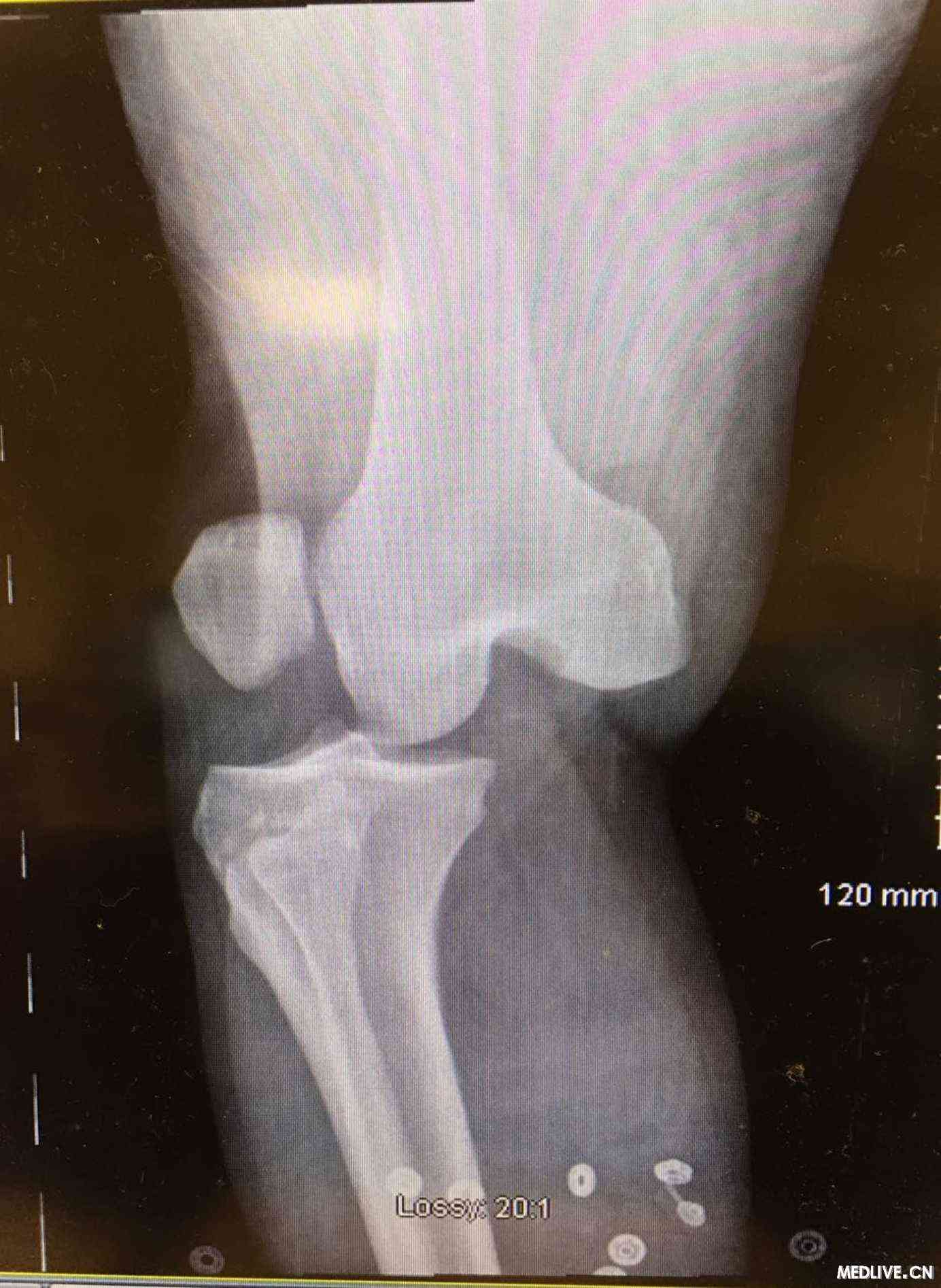患者,男,55岁.修剪树枝时从楼梯上摔下来,膝关节和膝盖骨脱臼.