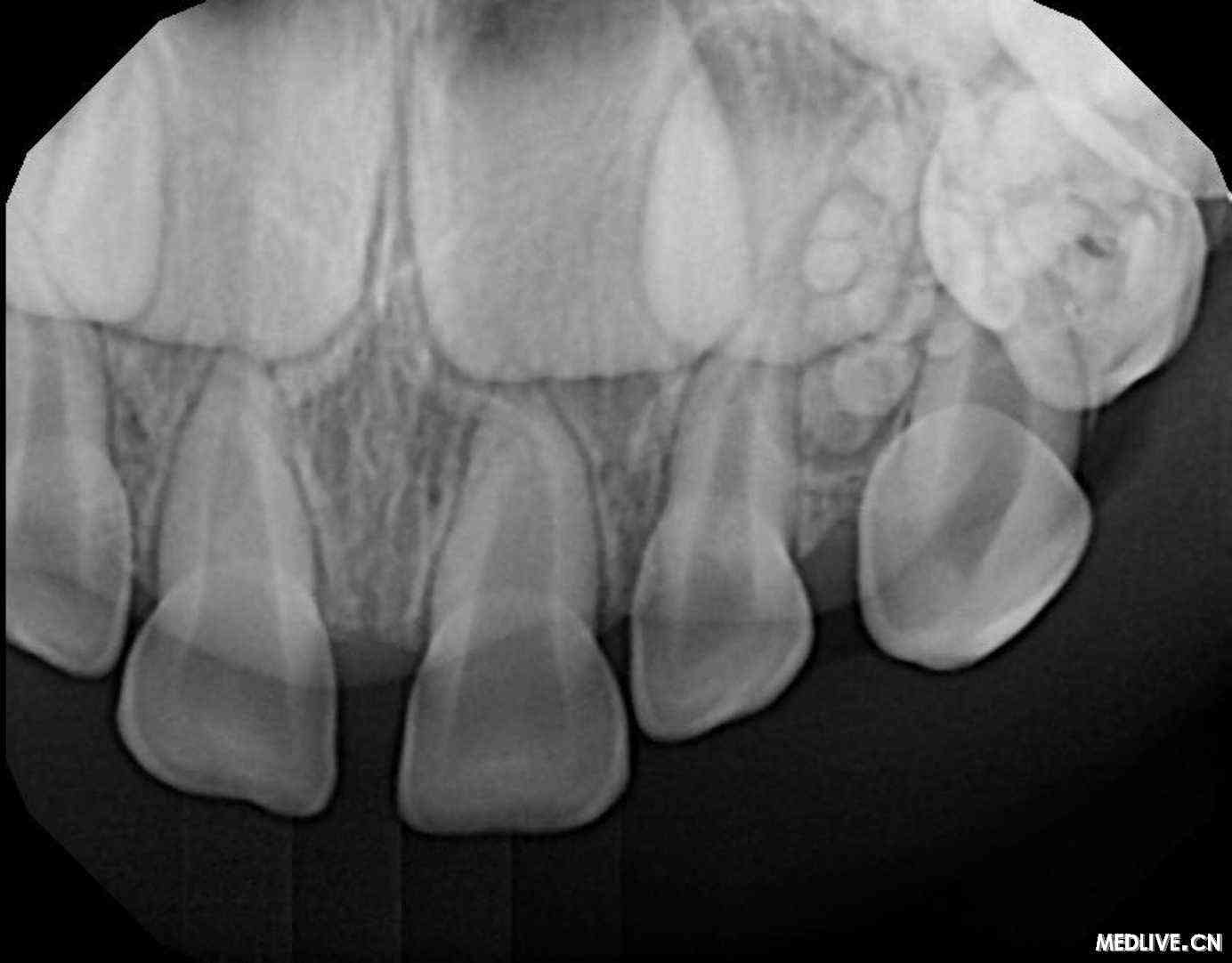 患者,女,4岁.最初是牙齿错位,牙片检查显示是牙瘤,如图所示.
