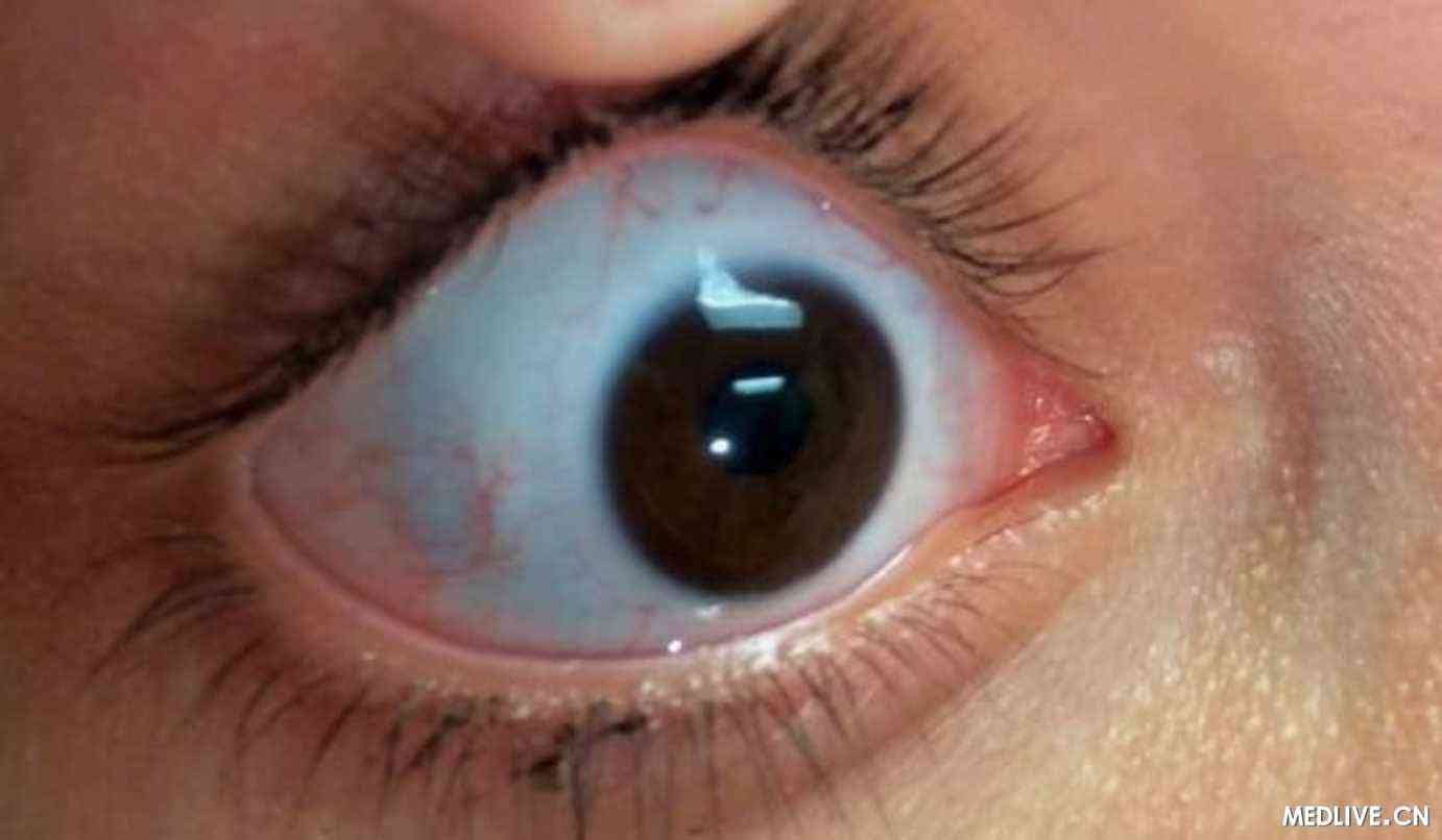 患者双眼出现蓝巩膜,图示为右眼的症状.患者陈述:母系