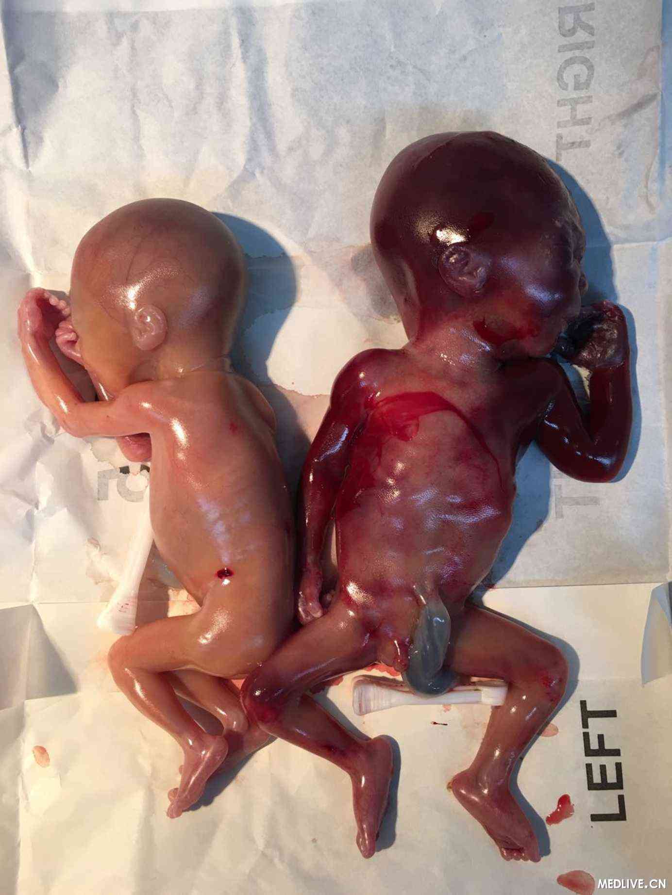 患儿,20周,aog,g4p3(3003),多胞胎妊娠,早产,孩子出生后没多久就死亡