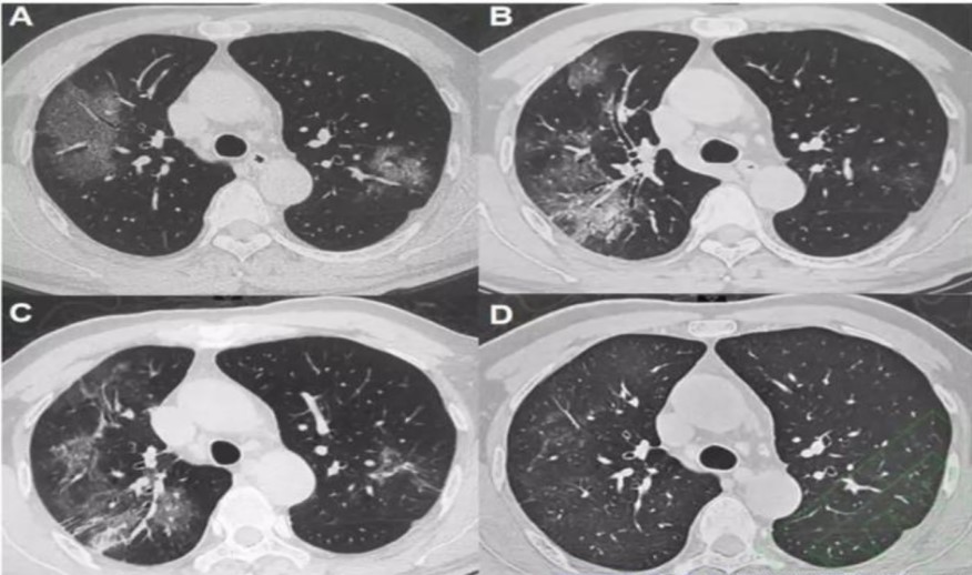 新型冠状病毒感染的肺炎,不同时期ct影像学表现