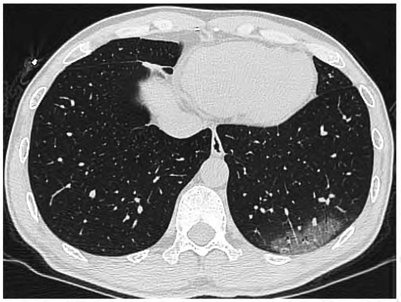 新冠肺炎(早期)ct示左肺上叶胸膜下扇形磨玻璃密度影,其内可见
