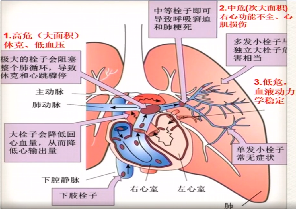 (3)急性肺栓塞的临床危险分层(图3)    高危:大面积血栓,临床表现