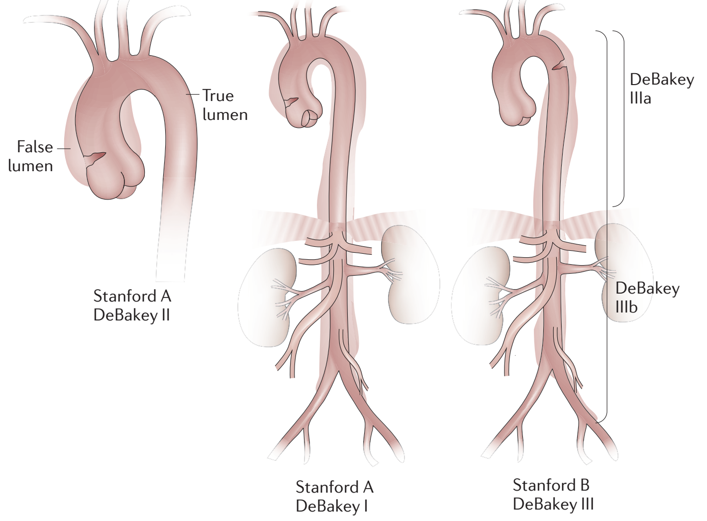主动脉夹层及其分型