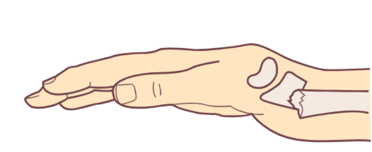 15 伸直型骨折的"银叉"畸形:骨折远端桡骨小头嵌入,并向后移位,成角