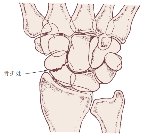 舟状骨骨折   舟状骨骨折约占腕部损伤的75%以上(图 137.