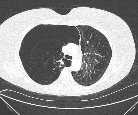 copd患者并发气胸常有严重的呼吸困难和急性呼吸衰竭的临床表现,可能