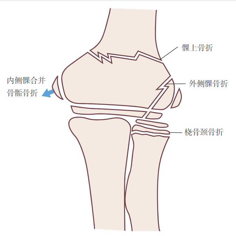 图137.10 儿童肘关节周围骨折和撕脱伤