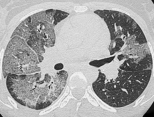 肺门周围网状和边界不清的磨玻璃影,3-4天内常发展为肺实变