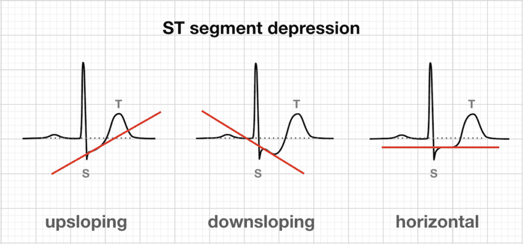 st段上斜型压低并非心肌缺血的特异性心电图改变.