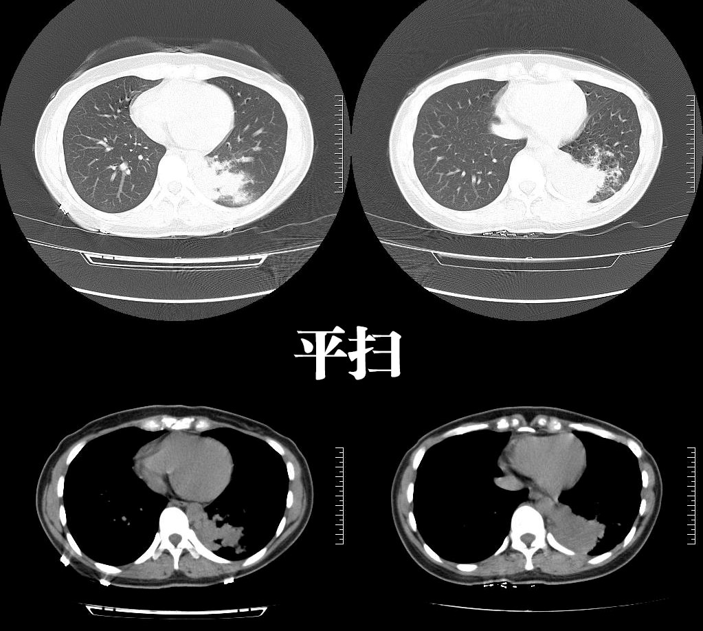 年轻女子咳嗽,咳痰2年,病因不寻常…_肺隔离症_医脉通